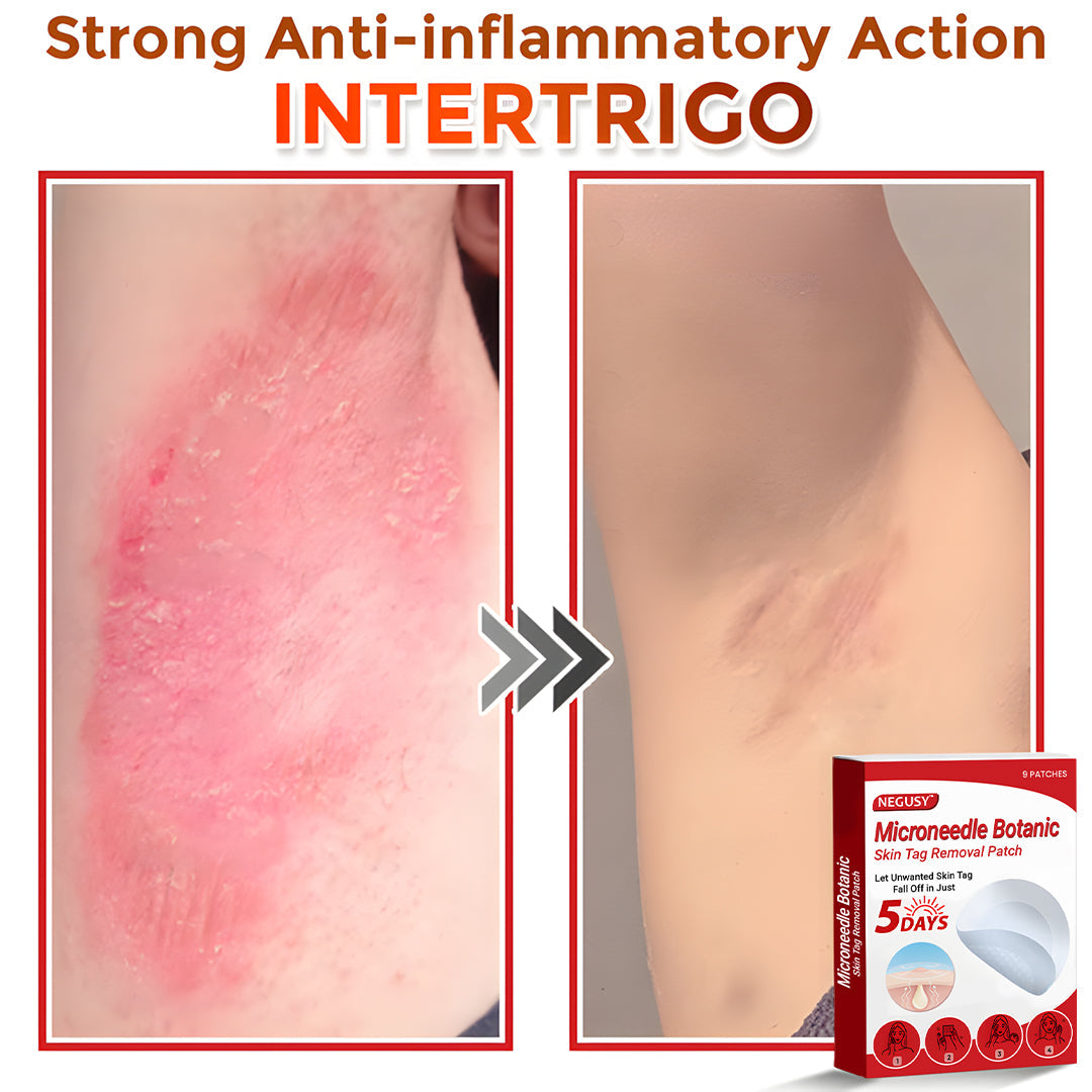 ✨Limited Time Discount🌿 Negusy™ MicroNeedle Skin Tag Remover Patch – Plant-Based & Painless