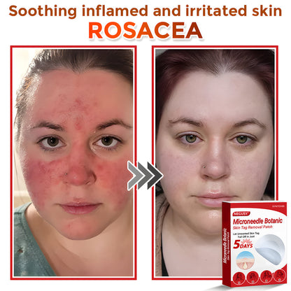 ✨Limited Time Discount🌿 Negusy™ MicroNeedle Skin Tag Remover Patch – Plant-Based & Painless